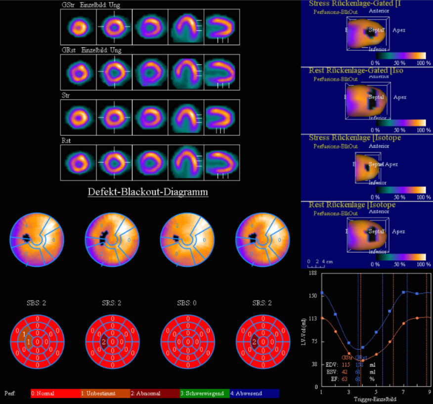 Herzszintigrafie in der Nuklearmedizin: Durchblutung und Pumpfunktion des Herzens nach Herzinfarkt, Stenteinlage oder Bypass-Operation, Herzschwäche